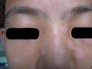 白癜风患者可以吃瓜吗,西瓜的食用建议